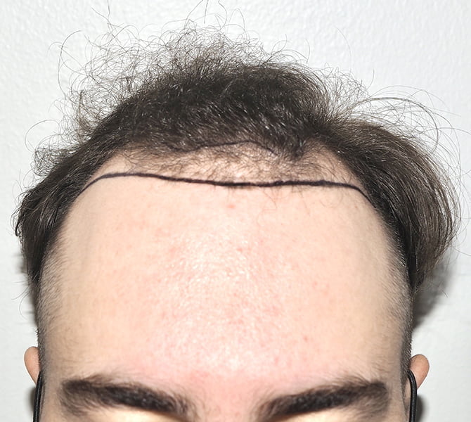 Hair Transplant Surgery | Hair Transplant Specialists - NYC
