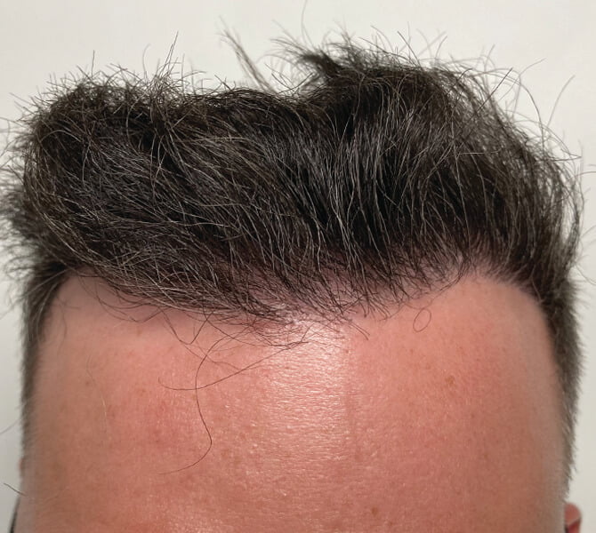 Hair Transplant Surgery | Hair Transplant Specialists - NYC